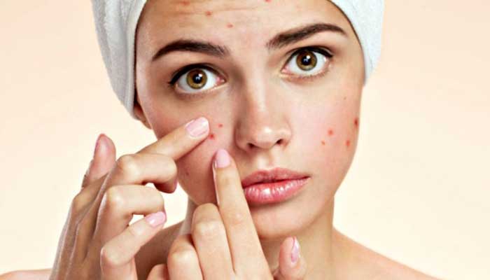 Prevenir-el-acne