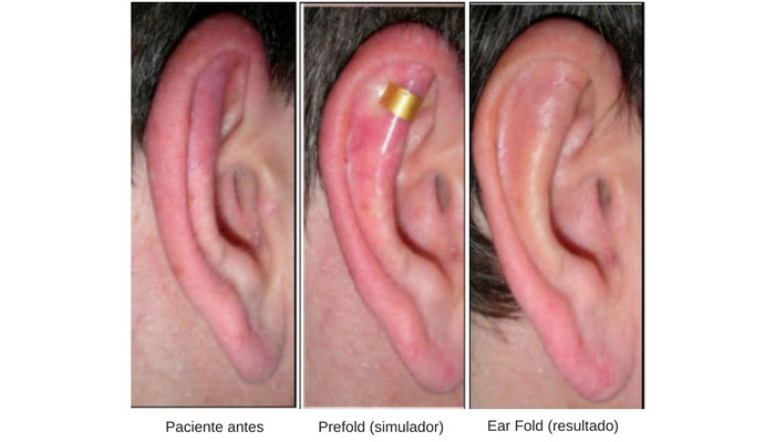 Antes-Y-Después-De-El-Implante-Ear-Fold